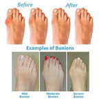 Bunion corrector sandals women's orthopedic arch support wedge toe-ring design