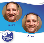 Clip-on veneers upper and lower set snap-on smile cover for stained or crooked teeth