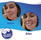 Clip-on veneers upper and lower set snap-on smile cover for stained or crooked teeth