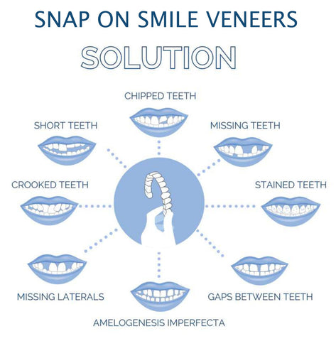 Clip-on veneers upper and lower set snap-on smile cover for stained or crooked teeth